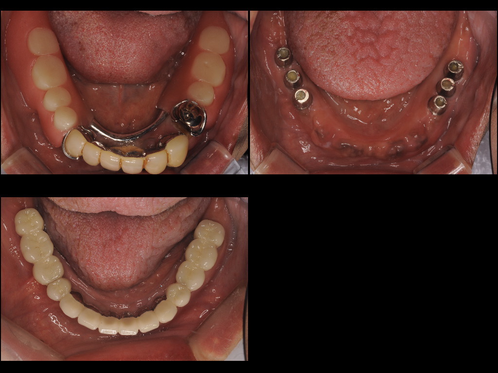 インプラント症例１：森歯科医院＠山形