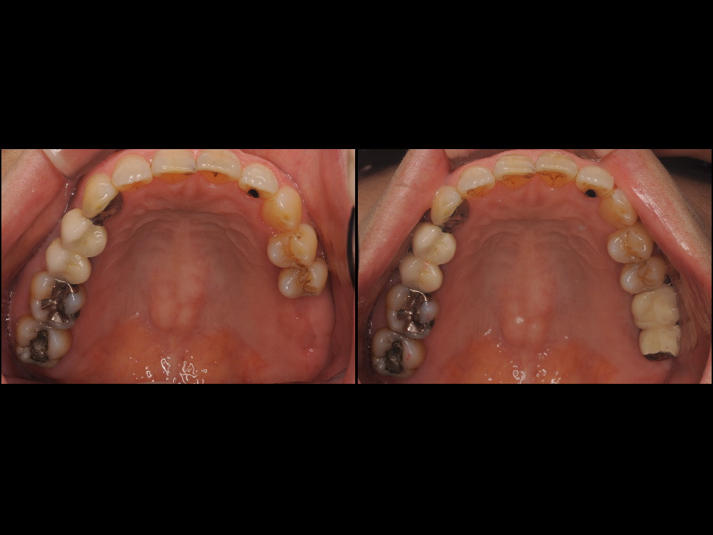 インプラント症例8：森歯科医院＠山形