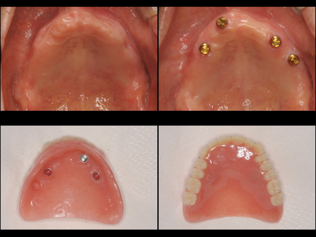インプラント症例２：森歯科医院＠山形