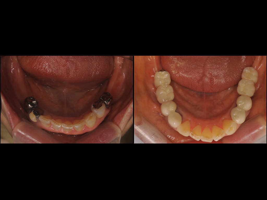 インプラント症例４：森歯科医院＠山形