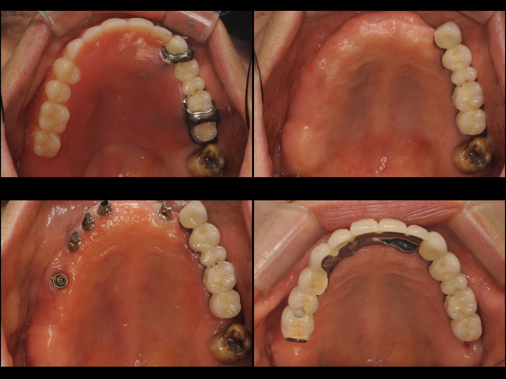 インプラント症例７：森歯科医院＠山形